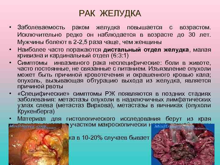 РАК ЖЕЛУДКА • Заболеваемость раком желудка повышается с возрастом. Исключительно редко он наблюдается в