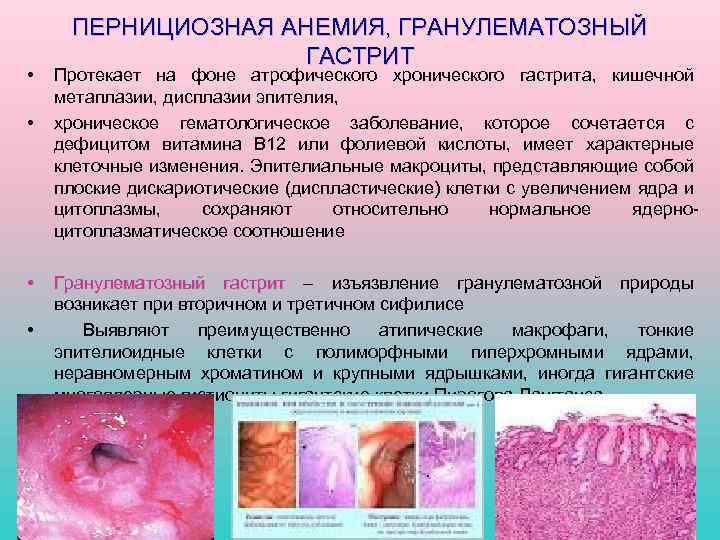  • • ПЕРНИЦИОЗНАЯ АНЕМИЯ, ГРАНУЛЕМАТОЗНЫЙ ГАСТРИТ Протекает на фоне атрофического хронического гастрита, кишечной