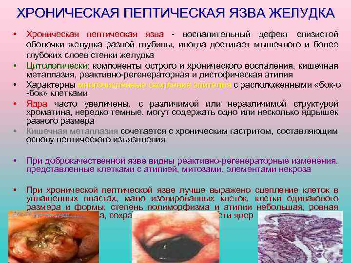 ХРОНИЧЕСКАЯ ПЕПТИЧЕСКАЯ ЯЗВА ЖЕЛУДКА • • • Хроническая пептическая язва - воспалительный дефект слизистой
