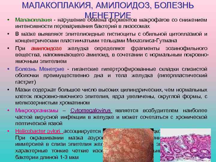  • • МАЛАКОПЛАКИЯ, АМИЛОИДОЗ, БОЛЕЗНЬ МЕНЕТРИЕ Малакоплакия - нарушение обмена ферментов макрофагов со