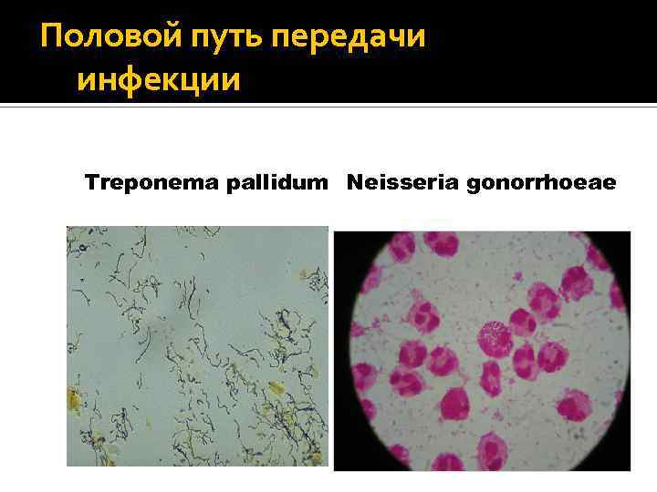 Половой путь передачи инфекции Treponema pallidum Neisseria gonorrhoeae 