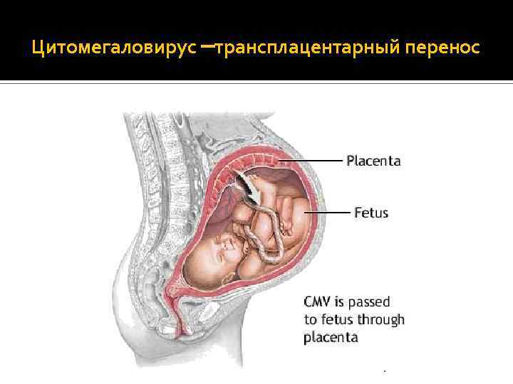 Цитомегаловирус –трансплацентарный перенос 