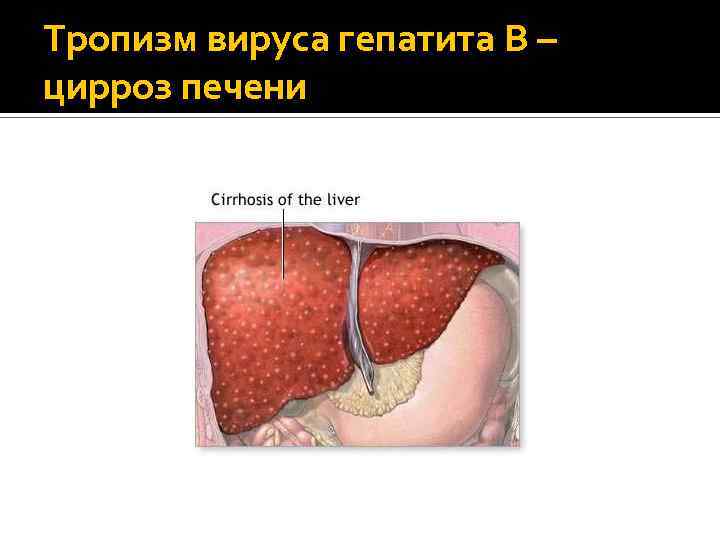 Тропизм вируса гепатита В – цирроз печени 