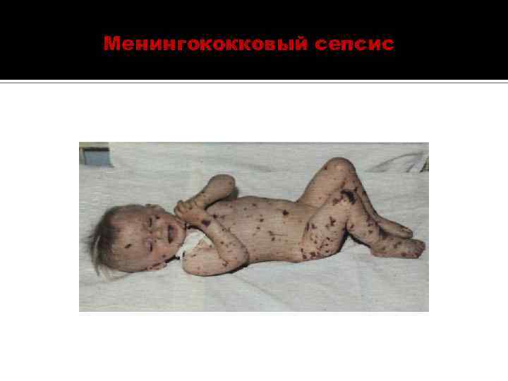 Менингококковый сепсис 