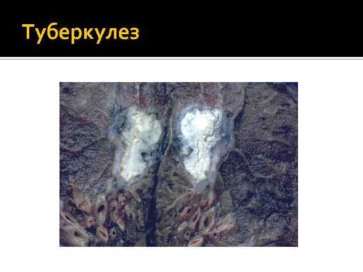 Туберкулез 