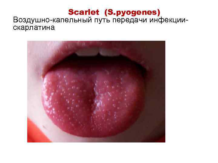 Scarlet (S. pyogenes) Воздушно-капельный путь передачи инфекциискарлатина 