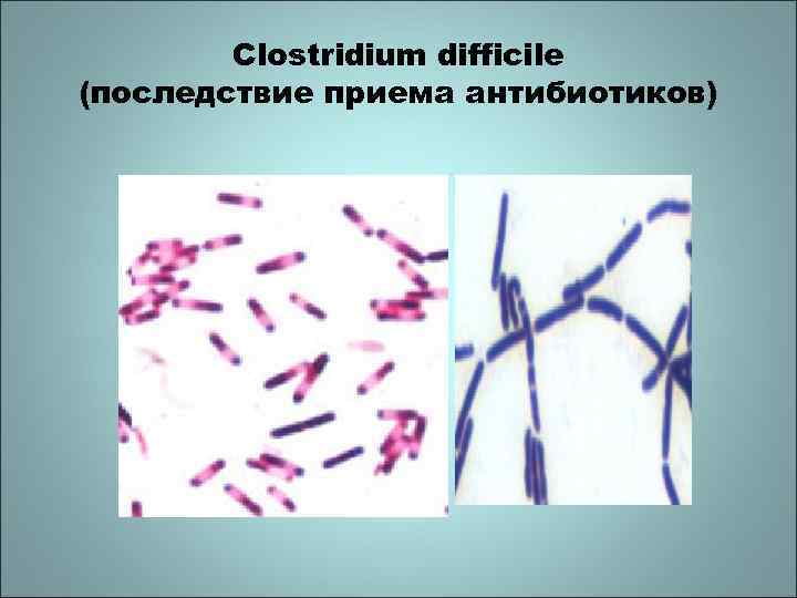 Clostridium difficile (последствие приема антибиотиков) 