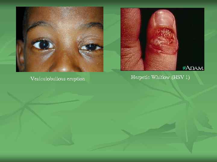 Vesiculobullous eruption Herpetic Whitlow (HSV 1) 