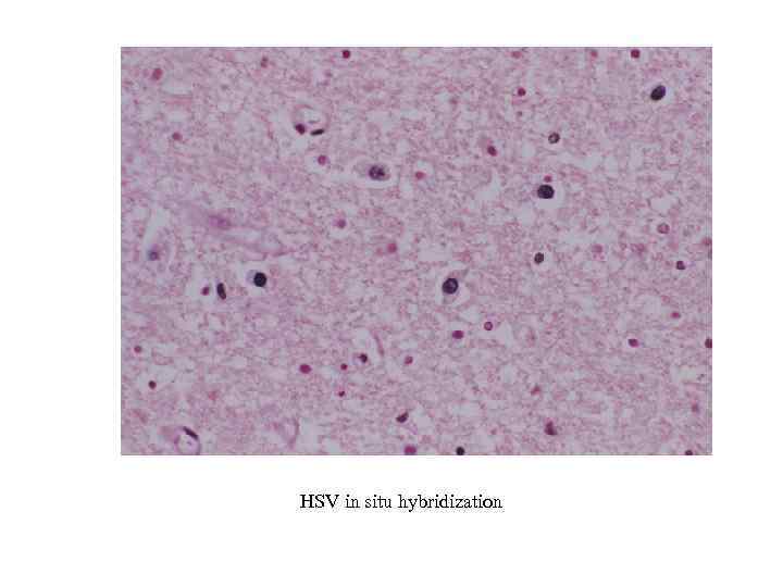 HSV in situ hybridization 