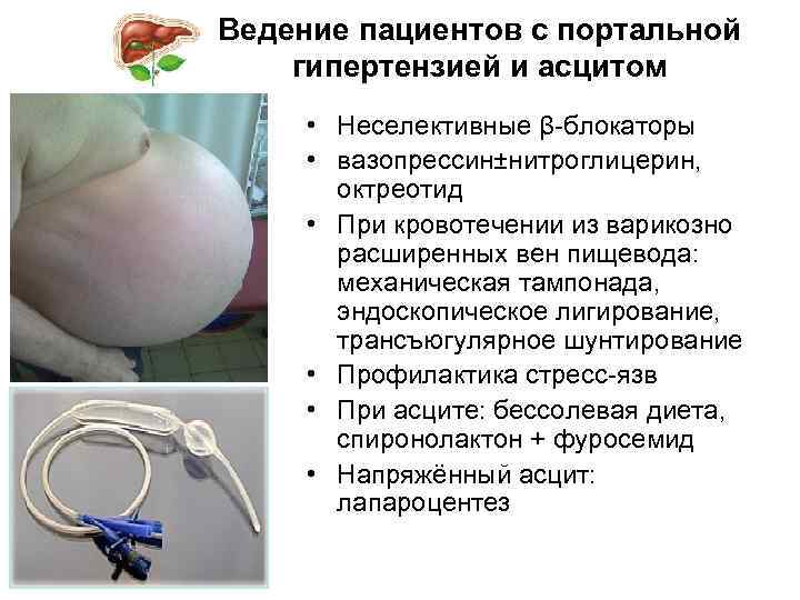 Ведение пациентов с портальной гипертензией и асцитом • Неселективные β-блокаторы • вазопрессин±нитроглицерин, октреотид •