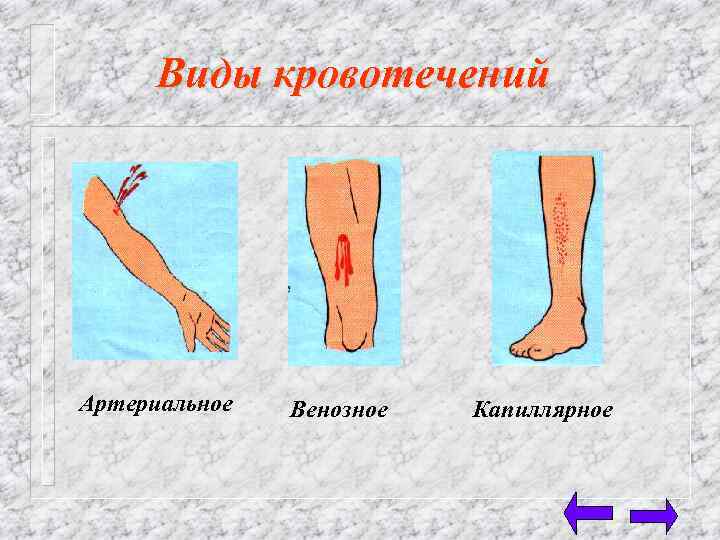 Виды кровотечений Артериальное Венозное Капиллярное 