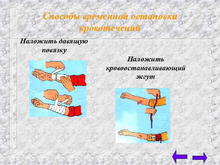 Способы временной остановки кровотечений Наложить давящую повязку Наложить кровоостанавливающий жгут 