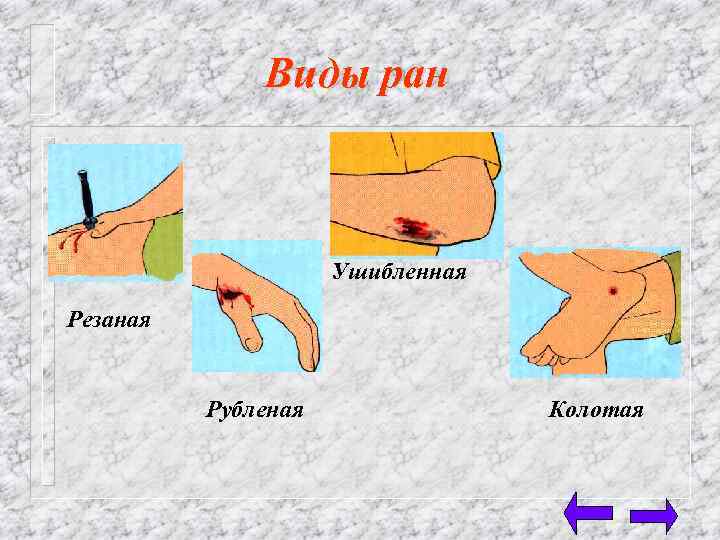 Виды ран Ушибленная Резаная Рубленая Колотая 