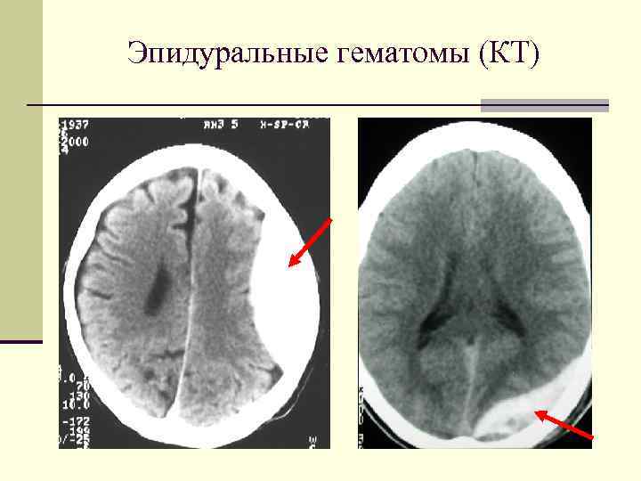 Эпидуральные гематомы (КТ) 