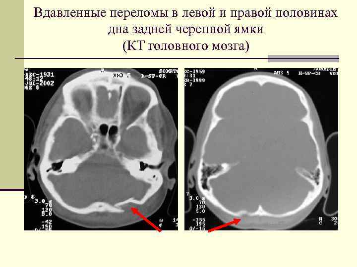 Вдавленные переломы в левой и правой половинах дна задней черепной ямки (КТ головного мозга)