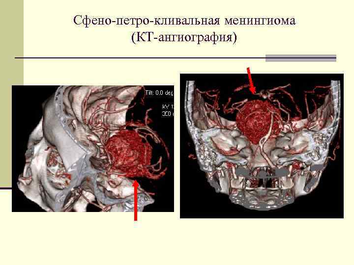 Сфено-петро-кливальная менингиома (КТ-ангиография) 