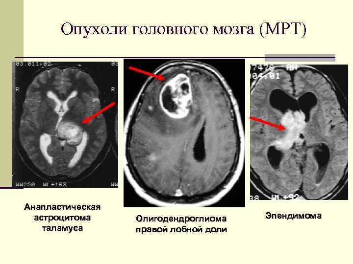 Опухоли головного мозга (МРТ) Анапластическая астроцитома таламуса Олигодендроглиома правой лобной доли Эпендимома 