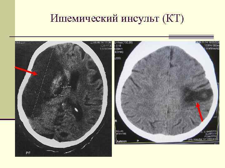 Ишемический инсульт (КТ) 