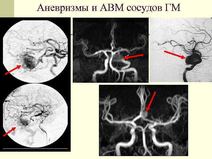 Аневризмы и АВМ сосудов ГМ 