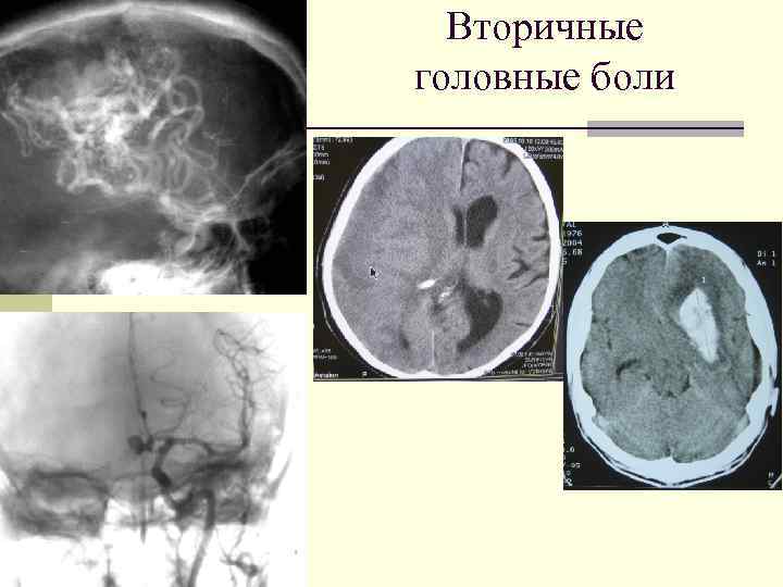 Вторичные головные боли 