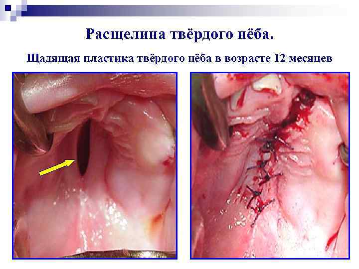  Расщелина твёрдого нёба. Щадящая пластика твёрдого нёба в возрасте 12 месяцев 