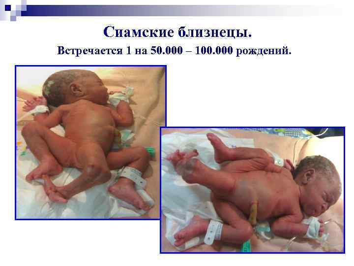  Сиамские близнецы. Встречается 1 на 50. 000 – 100. 000 рождений. 