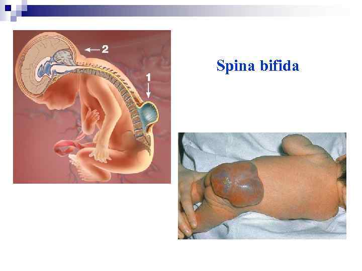 Spina bifida 