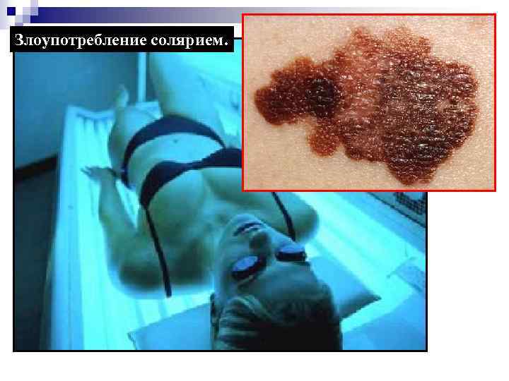 Злоупотребление солярием. 