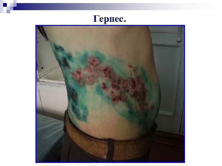 Герпес. 