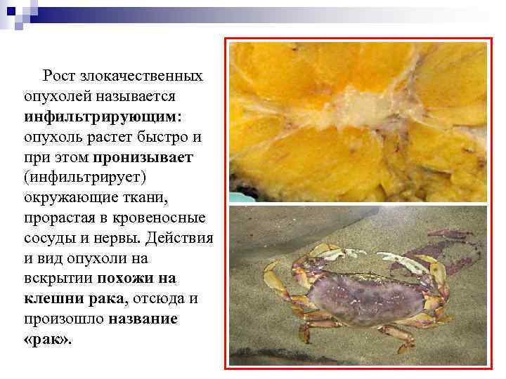  Рост злокачественных опухолей называется инфильтрирующим: опухоль растет быстро и при этом пронизывает (инфильтрирует)