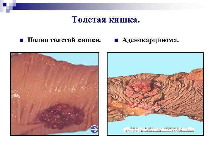 Толстая кишка. n Полип толстой кишки. n Аденокарцинома. 