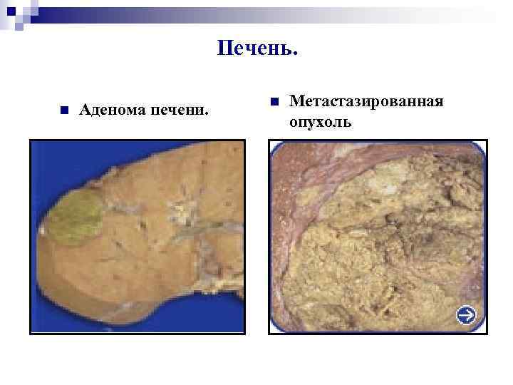 Печень. n Аденома печени. Метастазированная опухоль печени. n 