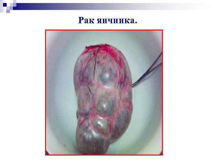 Рак яичника. 