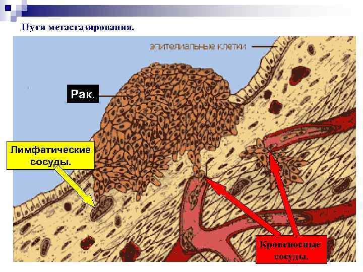 Пути метастазирования. Рак. Лимфатические сосуды. Кровеносные сосуды. 