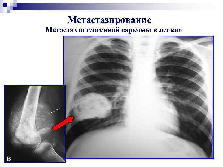 Метастазы на легких фото