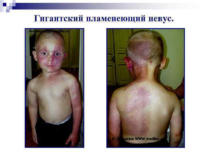 Гигантский пламенеющий невус. 