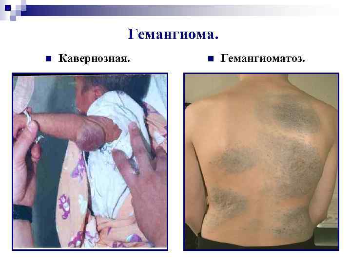 Гемангиома. n Кавернозная. n Гемангиоматоз. 