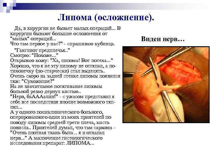 Липома (осложнение). Да, в хирургии не бывает малых операций. . . В хирургии бывают