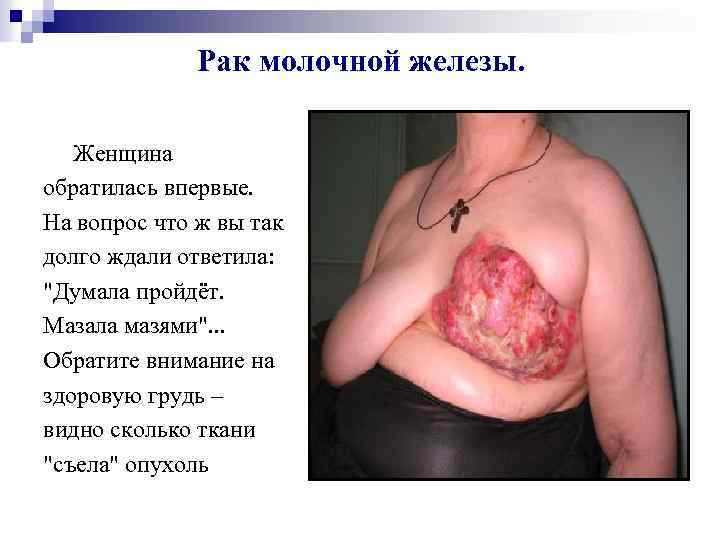 Рак молочной железы. Женщина обратилась впервые. На вопрос что ж вы так долго ждали