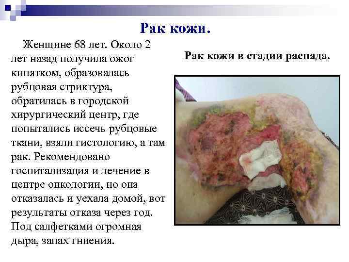 Рак кожи. Женщине 68 лет. Около 2 Рак кожи в стадии распада. лет назад