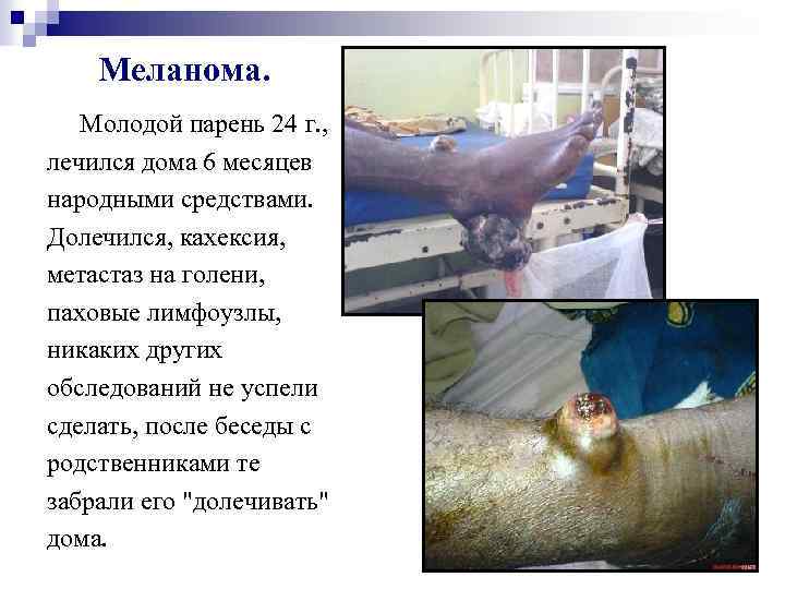  Меланома. Молодой парень 24 г. , лечился дома 6 месяцев народными средствами. Долечился,