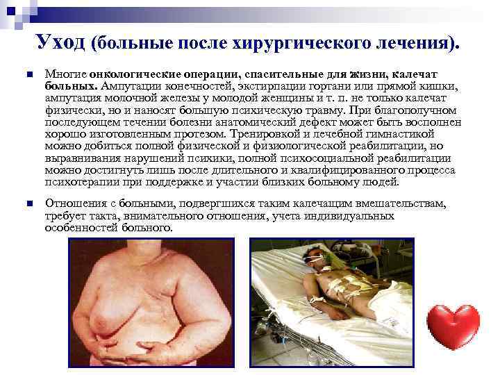 Уход (больные после хирургического лечения). n Многие онкологические операции, спасительные для жизни, калечат больных.
