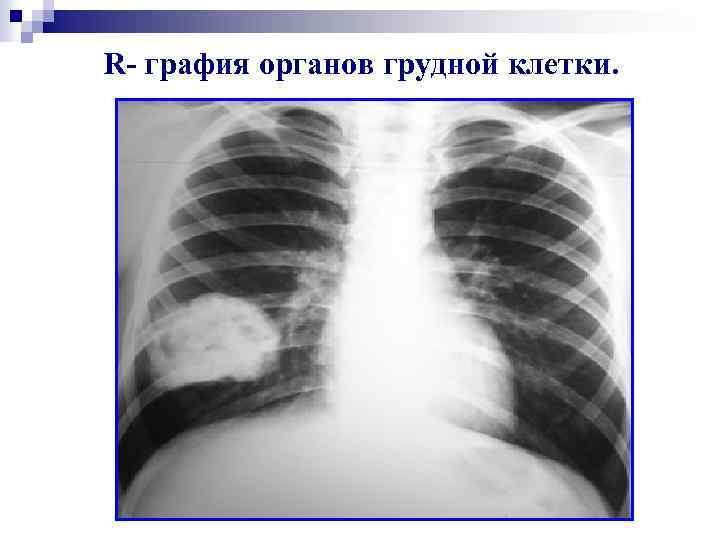 R- графия органов грудной клетки. 