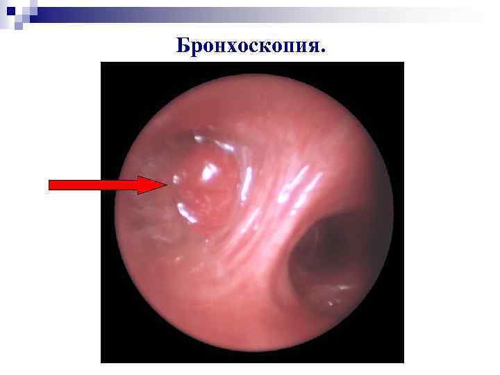 Бронхоскопия. 