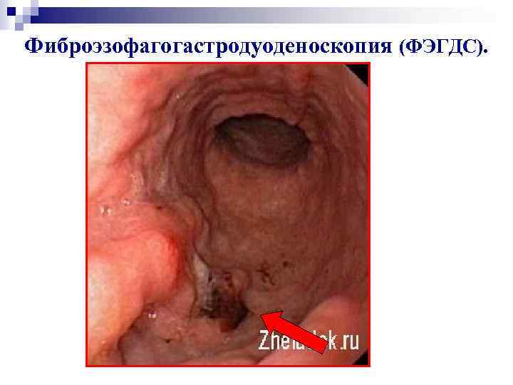 Фиброэзофагогастродуоденоскопия (ФЭГДС). 