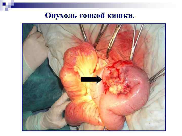 Опухоль тонкой кишки. 