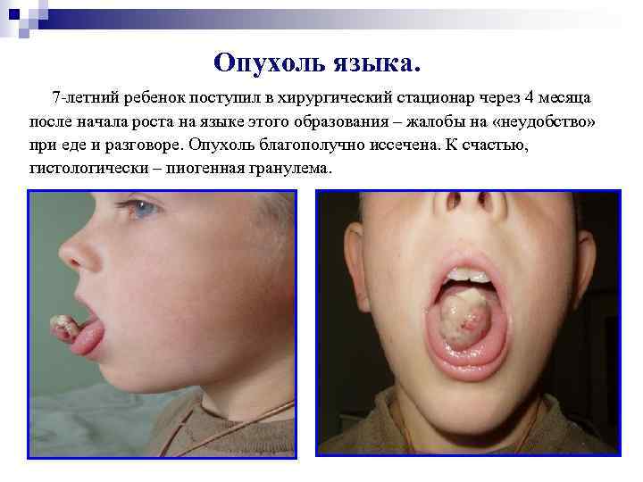 Опухоль языка. 7 -летний ребенок поступил в хирургический стационар через 4 месяца после начала