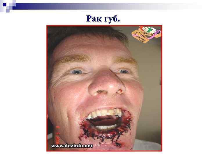 Рак губ. 