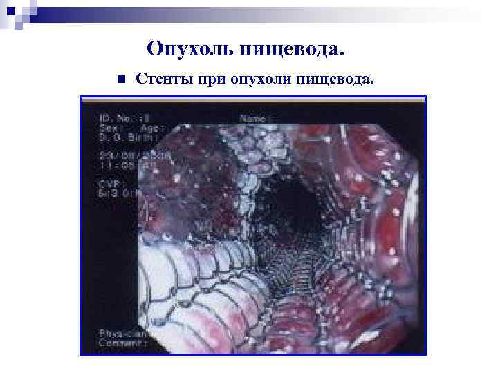 Опухоль пищевода. n Стенты при опухоли пищевода. 