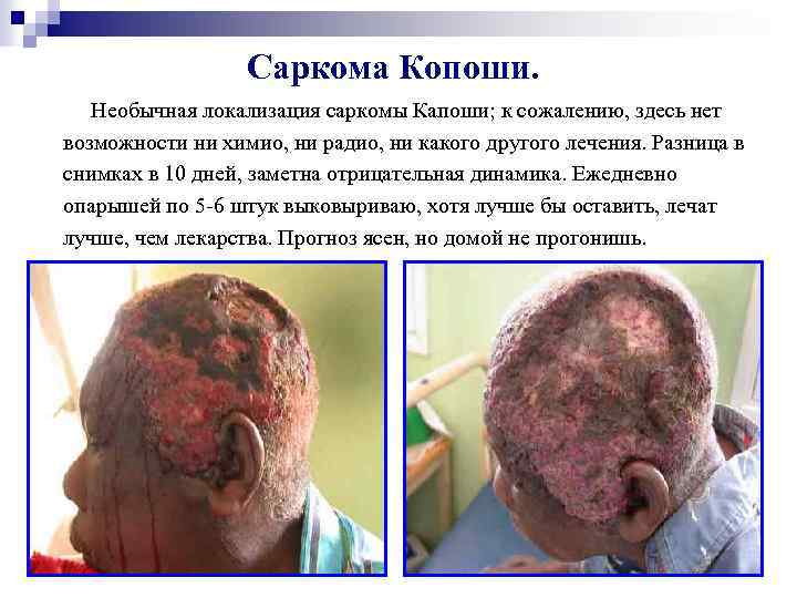 Саркома Копоши. Необычная локализация саркомы Капоши; к сожалению, здесь нет возможности ни химио, ни